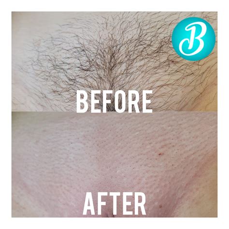 brazilian wax results|Brazilian Wax: What It Is, Prep and Aftercare .